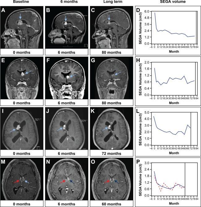 Moderne Therapieansätze Tuberöse Sklerose Everolimus: Verkleinert/hemmt Wachstum von SEGA (EXIST-1) Verkleinert/hemmt Wachstum von AML (EXIST-2)