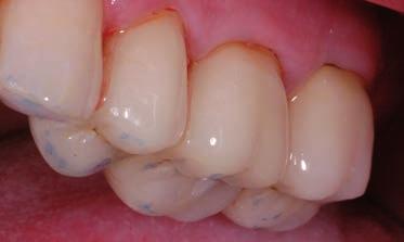 Wählen Sie GI oder RMGIZement, da dieser eine gute Feuchtigkeitstoleranz, bei hervorragender chemischer Haftung am Zahn bietet.