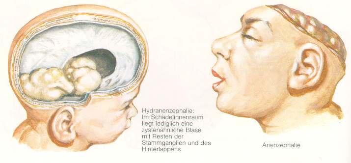 Anencephalie-Syndrom Hirnfehlbildung als pathologisch-isolative