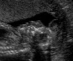 Zwillingsstudie Kurauchi et al (1995) Vergleich gesunder und anencephaler Zwillinge im dritten Trimester per Ultraschall: Beim anencephalen Fetus sind