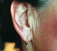 Die Falten vor dem Ohr zeigen einen deutlichen Mangel an Bindegewebe im Gesicht an, einen Mangel an Si.