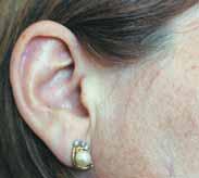 Allerdings ist er ausschließlich auf das Ohr beschränkt, denn schon am Rand des Ohrs zur Wange hin erscheint die bräunlich gelbliche Farbe von Ks.