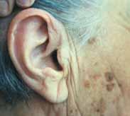 Der wächsern erscheinende Bereich ist in diesem Fall nicht nur auf das Ohr beschränkt, sondern erscheint auch vor dem Ohr zur Wange hin.