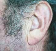 Vor dem Ohr beginnt sich der Mangel an Si in Form von feinen Fältchen abzuzeichnen. Die aufgedehnten bläulich wirkenden Adern zeigen einen Mangel an Kc.