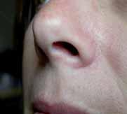 Die deutlich sichtbare wächserne Unterlegung der Augenbrauen zieht sich nicht nur über die ganze untere Stirn, sondern auch bis zur Nasenwurzel herunter.