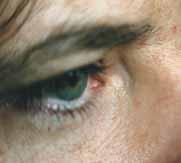Würfelfalten bzw. Karofalten: Mangel an Cf. Der bläulich schwärzliche Schatten an der Nasenwurzel innen ist außerordentlich stark ausgeprägt.