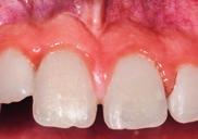 ZAHNMEDIZIN AKTUELL Sagen Sie Ahh 67 PRATIQUE QUOTIDIENNE ET FORMATION COMPLÉMENTAIRE Thérapie endodontique régénérative après