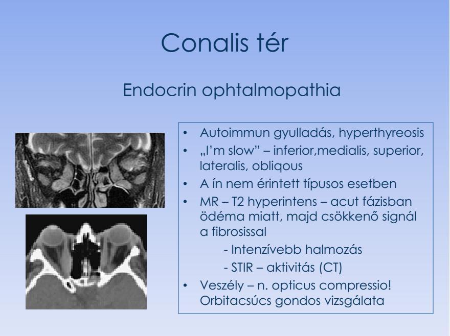 Konal Raum Endokrin Ophthalmopathie - Autoimmun Entzündung, Hyperthyreose - I m slow inferior, medialis, superior, lateralis, obliqus - Die Sehne is nicht