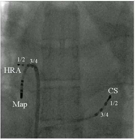 Fluoroskopische Katheterposition bei Terminierung Intrakardiale Signale bei Kardioversion von