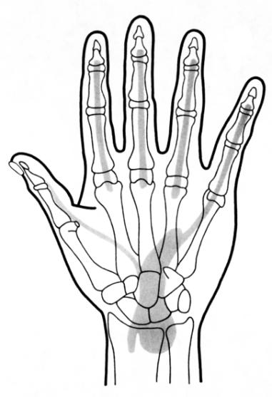 Brüche der Langfinger oder der Mittelhandknochen 2-5 - mit Gelenkbeteiligung - Betroffenheit mehrerer Strahlen - schwere Weichteilverletzungen entsprechend 1.5 (V). 8.