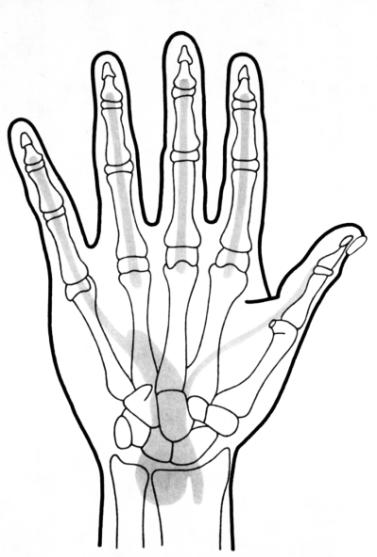 3 (S) Verletzungen der Handwurzel bei Brüchen mehrerer Handwurzelknochen singulären oder mehrfachen Bandverletzungen Verrenkungen Verrenkungsbrüchen. 8.