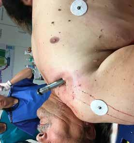 Pneumothoraxdiagnostik Fall: Sturz auf eine liegende Trittleiter, penetrierende Thoraxverletzung.
