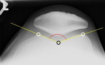 Einleitung 1.3 Grundlagen der Trochleadysplasie Wird das Patellartracking maßgeblich durch eine anormal geformte Gleitrinne gestört, spricht man von einer Trochleadysplasie.