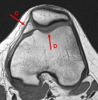 Weitere Zeichen einer Trochleadysplasie sind die ventrale Erhöhung der Trochlea, sowie das Vorhandensein eines ventralen Sporns [6].