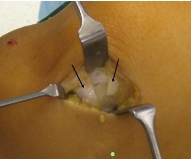 Material und Methoden Abbildung 22: Implantatfreie patellare Fixation über den V-förmigen