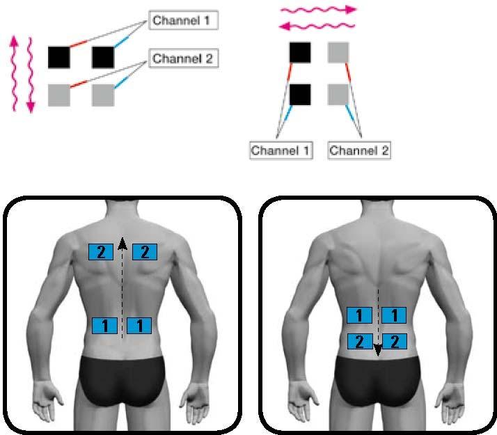 Mischinkontinenz und Stressinkontinenz Elektrodenanlage für die dynamische Stimulation Auf- oder absteigende Bewegung Für Rücken oder Beine Seitwärts Bewegung für Gesäß- oder Bauchmuskel Aufsteigende