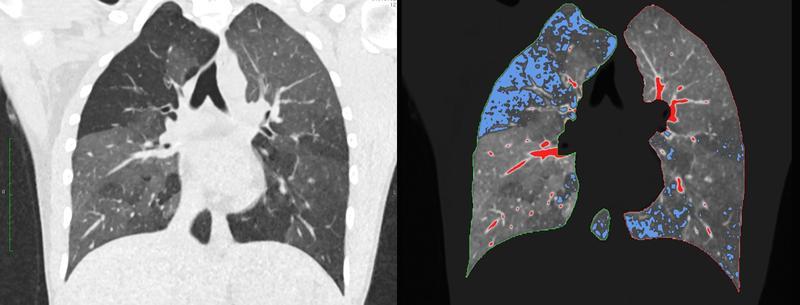 Linke Seite: reguläres CT bei Verdacht auf COPD. Rechte Seite: darübergelegtes qct.