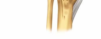 Wie ist das Kniegelenk aufgebaut? Das Kniegelenk ist ein grosses und kompliziertes Gelenk. Das Gelenk ist starken Belastungen ausgesetzt und deshalb sehr verletzungs- und verschleissgefährdet.