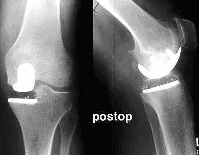 Die Hemiarthroplastik des Knies Wie verläuft die Operation? Die Operation kann entweder in Vollnarkose oder in Spinalanästhesie durchgeführt werden.