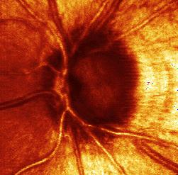 Bestimmung der retinalen Kapillardichte.