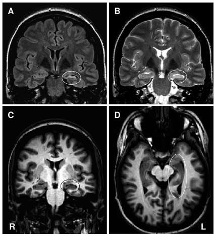 Abbildung 2: MRI mit koronaren FLAIR-Aufnahmen (A), koronaren T2-Aufnahmen (B) sowie koronaren und transversalen T1-Aufnahmen (C und D) in temporaler beziehungsweise hippocampaler Angulierung bei