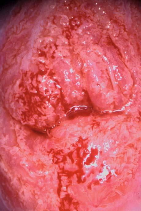 Schema Ektopie. Das Drüsenepithel ist noch nicht metaplastisch umgebaut und auf der äußeren Zervix sichtbar (rechts). Abb. 2.6.