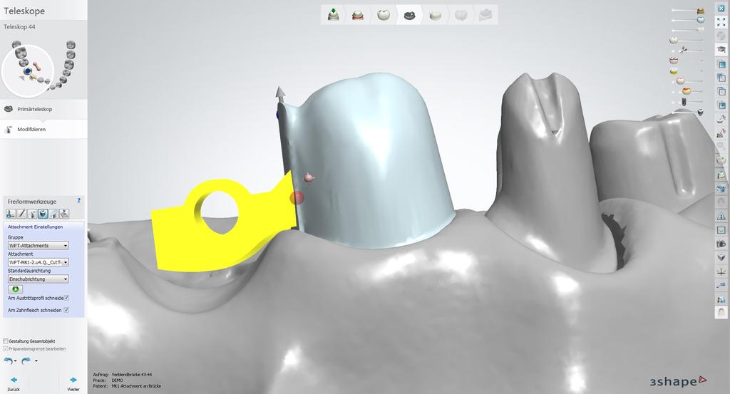 Konstruktion Zahn 44 Modifizieren: Attachment