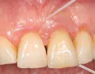 Bilder 44 45 Hygienemaßnahmen: Es muss möglich sein, die Zahnseide auf beiden Seiten um das