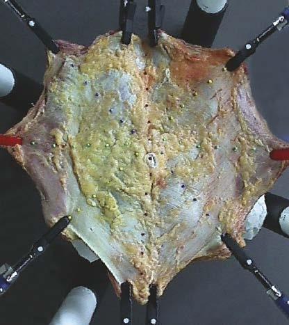 Bauchwandexplantat Untersuchung an explantierten Bauchwänden (Quelle: Universitätsklinikum Aachen) Extreme Weiterreißfestigkeit Konventionelle textile Implantate haben eine Schwachstelle: einmal