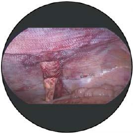 Optimales Handling Das Implantat besteht aus einem einzigen Stück, deshalb ist der Übergang in die Intestinalmanschette nahtfrei!
