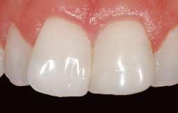 2. Mehrfarbige Restauration der Klasse IV Zahnärztliche Behandlung und Fotos von Dr. Marcos Vargas, University of Iowa, Iowa City (USA).