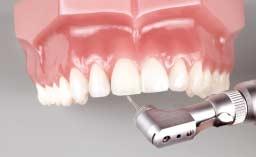 Ästhetischer Vorschlag: Für die Füllung an einem typischen Modell- Zahn empfehlen wir Filtek Supreme XT Universal Composite