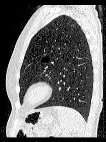 Niedrig-Dosis-CT in der Lungenbildgebung mit SAFIRE 1) SOMATOM Definition AS (64-Schicht-Konfiguration) 0,18 msv bei