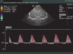 Gleichzeitig ist der Abfall der maximalen systolischen Flussgeschwindigkeit möglich. Der Resistance-Index ist erhöht. Die Prognose ist sehr schlecht, der Hirntod ist möglich (Abb. 5).