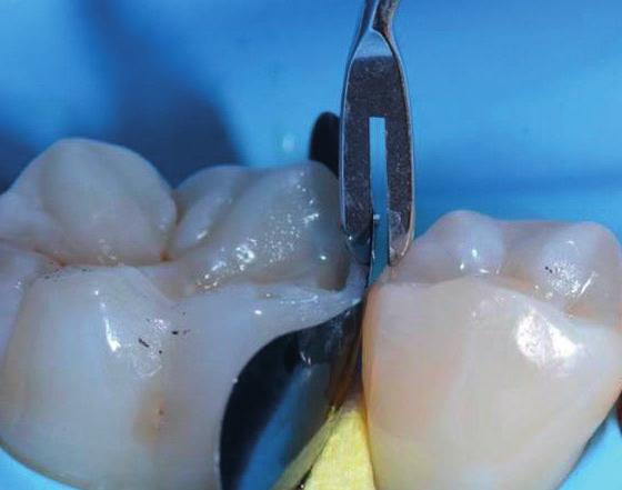 Die konische Spitze ist perfekt fürs Imitieren der Anatomie des Okklusalbereiches eines posterioren Zahns mit nur einem Instrument.