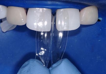 1Vorbereitung des Zahns Entfernen Sie den Biofilm Verwenden Sie den Biolcear Blaster, gefüllt mit Aluminiumtrihydroxid, um den Biofilm komplett zu entfernen und den Zahn für das Adhäsivsystem