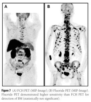Grenzen der FDG-PET 18F-NaF ist mehr sensitiv, vergleich mit 18F-Cholin Spezifizität für Tumore ist begrenzt Falsch positive Befunden Entzündung Aktivität des