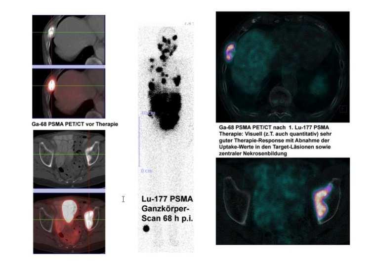 METABOLISCHE BILDGEBUNG MIT HIGH-END PET/CT (MCT FLOW 64) ERSTE ERFAHRUNGEN UND PERSPEKTIVEN Prof. Dr. med. Richard P. Baum / Dr. med. Franz C.