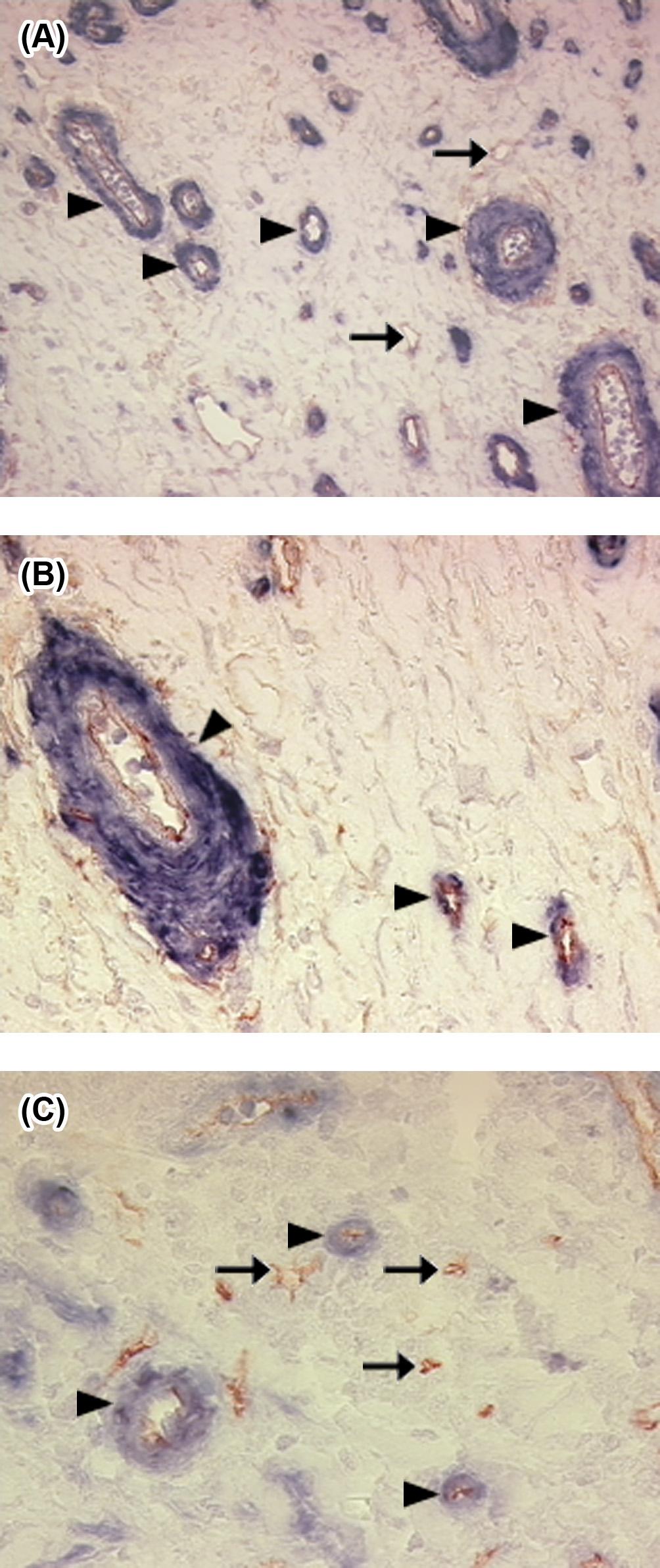 Abbildung 6: Immunhistochemische Darstellung der Gefäßmaturität. Darstellung des Perizytenbesatzes (MVM) mittels immunhistochemischer Doppelfärbung gegen CD34 (Endothelzellen) und α-sma (Perizyten).