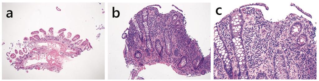 Pouchitis - Pathologie normale Dünndarmschleimhaut Verplumpung der Villi,