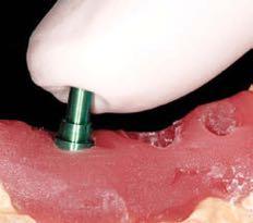 Abdrucknahme auf Implantatniveau Inserieren des grünen 1 Abruckpfostens