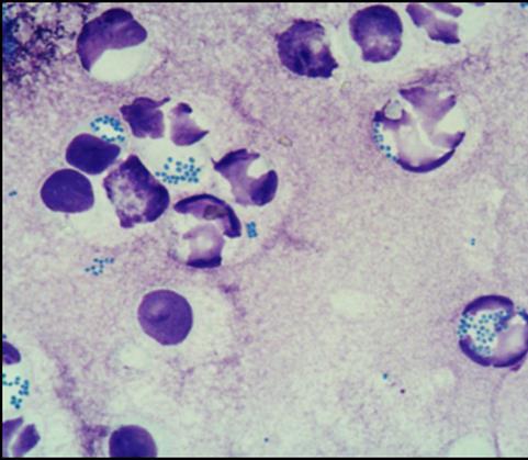 Infektiöse Otitis externa: Staphylokokken Alle sollten wirksam sein (in vitro Daten) Auswahlkriterien: Trommelfell