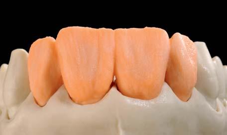 2.5 Dentin-Schneide-Schichtung Korrekturschichtung Zur Reproduktion der Konfektionsfarben wird HeraCeram Zirkonia in einer einfachen 2-Schicht-Technik mit Dentinund Schneidemassen