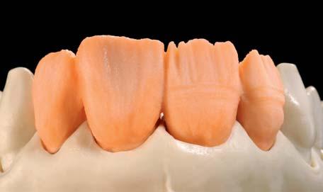 Der Dentinkern kann entweder direkt gestaltet werden, oder, zur besseren Kontrolle der Größe und Stellung des Zahnes, zunächst voll ständig aufgebaut und anschließend reduziert
