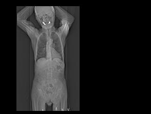 PET/CT Standard Protocol PET/CT tomograph Fused image PET image Topogram Upper limit CT PET 3D