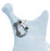 Plattentyp Indikationen 1.0 mm (verformbar) Zuggurtung Adaption Gitter/3D Unterkieferfrakturen Orthognatische Chirurgie 1.