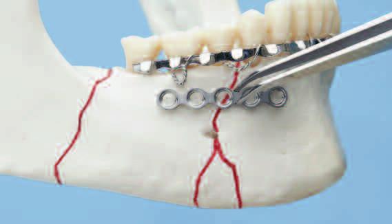 Vorsichtsmassnahmen: Darauf achten, die Plattenlöcher nicht über dem Nerv oder der Zahnwurzel zu platzieren.