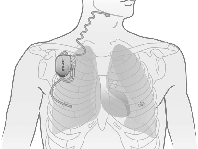 3. Obere Atemwegstimulationsbehandlung (UAS) von Inspire Ihr Inspire-System Stimulationselektrode Stimulator Atmungsdetektionselektrode Abbildung 2.
