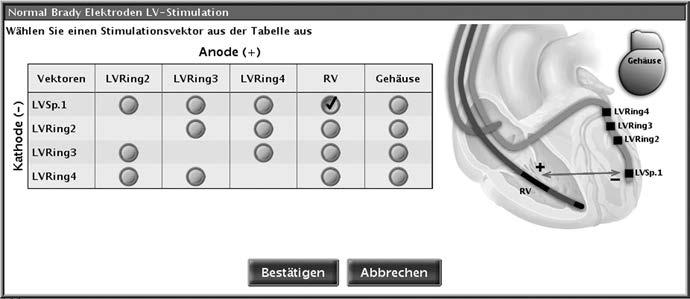 Stimulations-Therapien Elektrodenkonfiguration 4-65 3. Wählen Sie in der Tabelle die Option aus, die der gewünschten Kathoden-Anoden- Kombination entspricht.