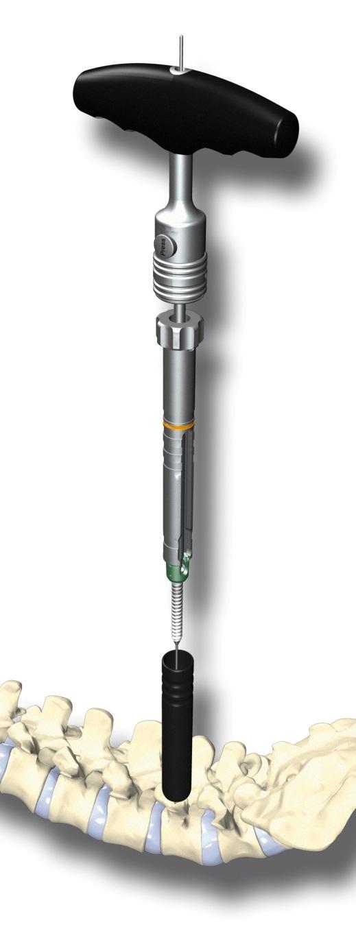 12) Implantieren der Schraube Die ucentum Schraube wird über den liegenden Führungsdraht mit dem Schraubendreher (CS 3826) inklusive Führungshülse implantiert.
